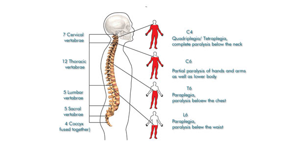 Spinal Cord Injury Quizzes, Spinal cord injury Trivia, Spinal cord injury Questions