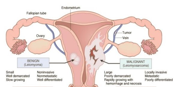 Neoplasia Quizzes, Neoplasia Trivia, Neoplasia Questions