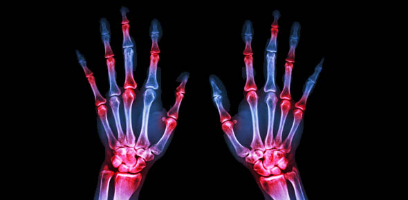 Rheumatology Quizzes, Rheumatology Trivia, Rheumatology Questions