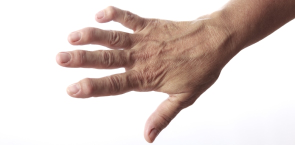 Rheumatoid Arthritis Quizzes, Rheumatoid arthritis Trivia, Rheumatoid arthritis Questions